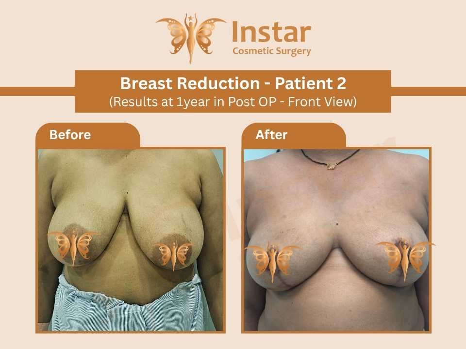 Breast Reduction (Results at 1year in Post OP - Front View)